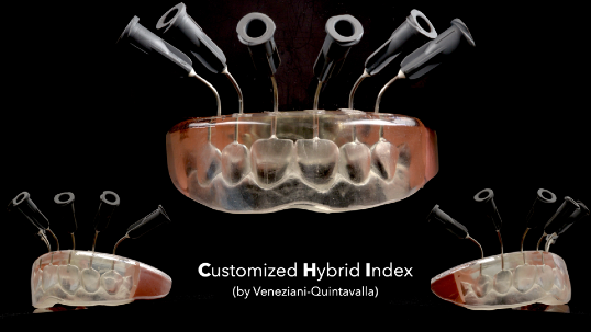 Customized Hybrid Index by Veneziani–Quintavalla, showing the index and injection access points