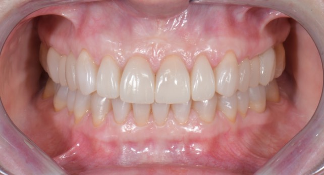 After treatment — Full-mouth clinical example