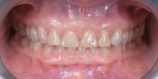 Before treatment — Full-mouth clinical example