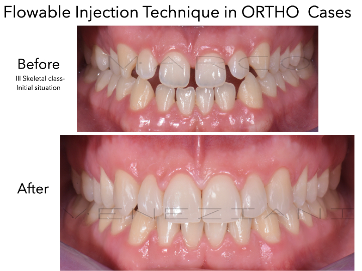 Before and after an orthodontic case; initial skeletal Class III situation, as labelled in the brochure
