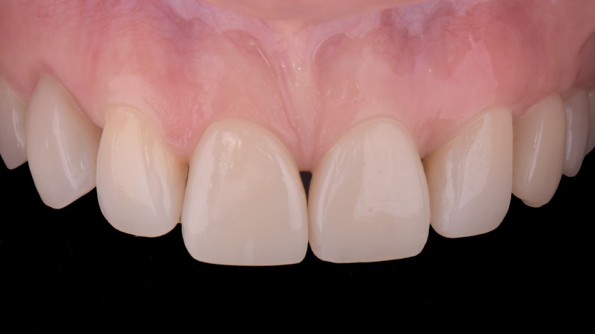 After treatment — Anterior restorative case