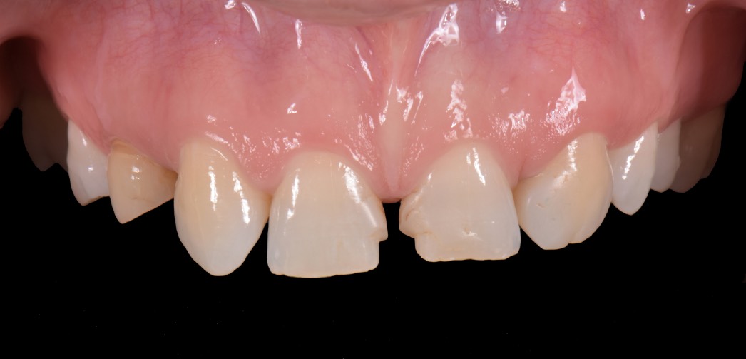 Before treatment — Anterior restorative case
